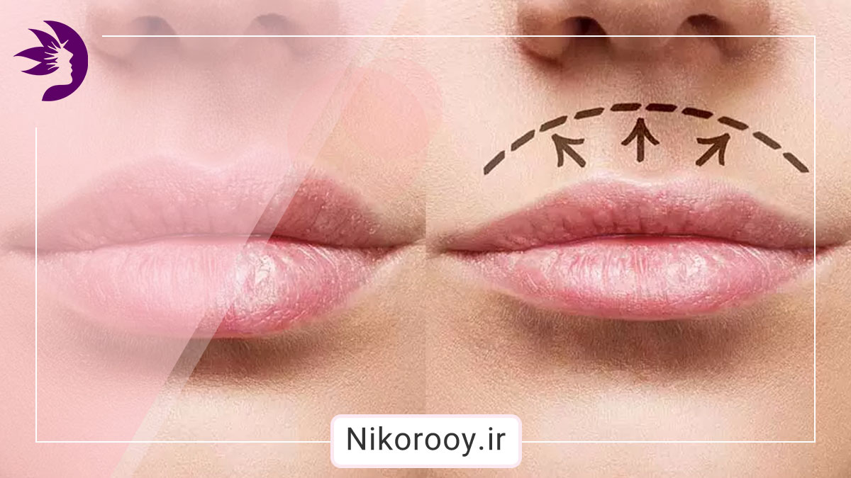 عمل لیفت سانترال لب چگونه است؟ آشنایی با مزایا و روند بهبودی جراحی.