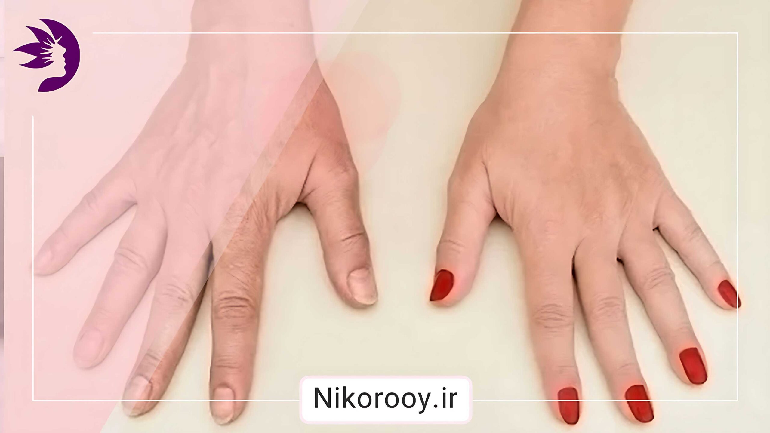 راهکارهای موثر برای جلوگیری از  پیری و چروک پوست دست